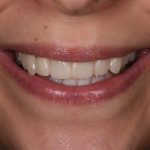 After Cosmetic Dentistry-1
