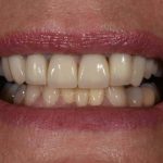After Cosmetic Dentistry-2
