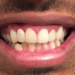 Cosmetic Dentistry Before and After | Patient 01 After | The Crown Dental Group