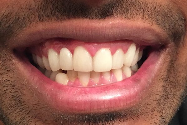 After01 Cosmetic Dentistry Before and After | Patient 01 After | The Crown Dental Group