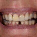 Before Cosmetic Dentistry-2