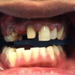 Cosmetic Dentistry Before and After | Patient 01 Before | The Crown Dental Group