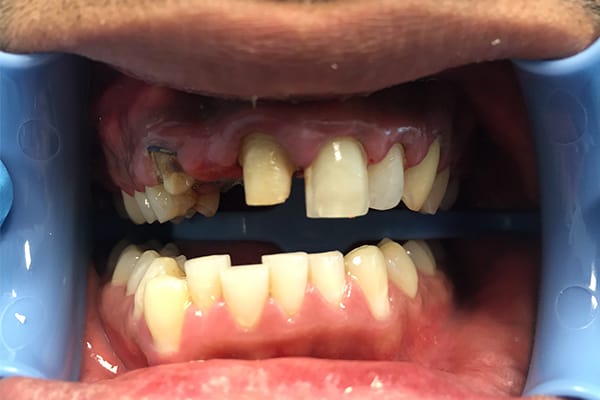 Before01 Cosmetic Dentistry Before and After | Patient 01 Before | The Crown Dental Group