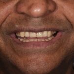 After Cosmetic Dentistry