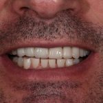 Cosmetic Dentistry Patient 3 After | The Crown Dental Group