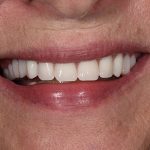 Denture Before and After | Patient 02 After | The Crown Dental Group