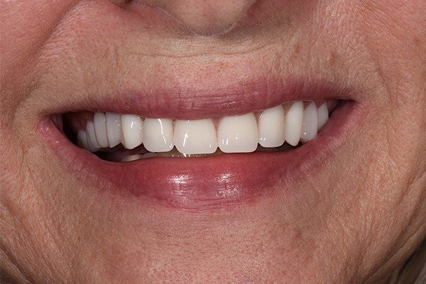 Denture-after-01 Denture Before and After | Patient 02 After | The Crown Dental Group