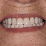 Denture Before and After | Patient 03 After | The Crown Dental Group