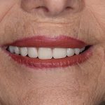 Denture Before and After | Patient 05 After | The Crown Dental Group