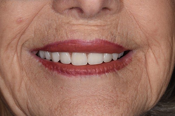 Denture-after-04 Denture Before and After | Patient 05 After | The Crown Dental Group