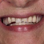 Denture Before and After | Patient 02 Before| The Crown Dental Group