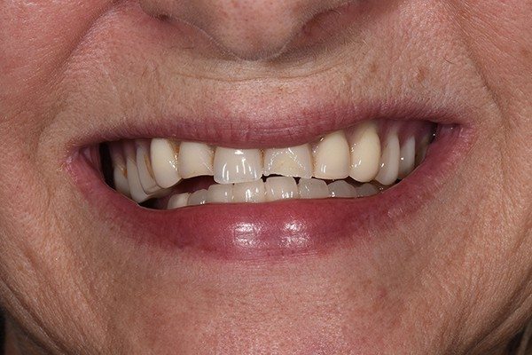 Denture-before-01 Denture Before and After | Patient 02 Before| The Crown Dental Group