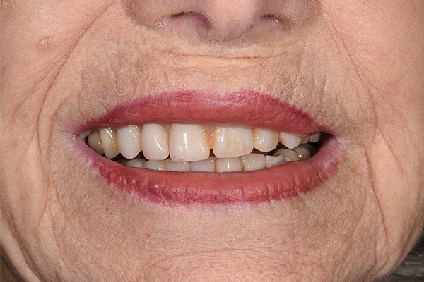 Denture-before-04 Denture Before and After | Patient 05 Before | The Crown Dental Group