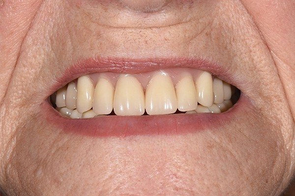 Denture-before02 Denture Before and After | Patient 03 Before | The Crown Dental Group