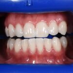 Teeth Whitening Before and After | Patient 01 After | The Crown Dental Group