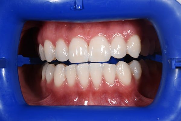 Whitening-after01 Teeth Whitening Before and After | Patient 01 After | The Crown Dental Group