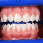 Teeth Whitening Before and After | Patient 02 After | The Crown Dental Group