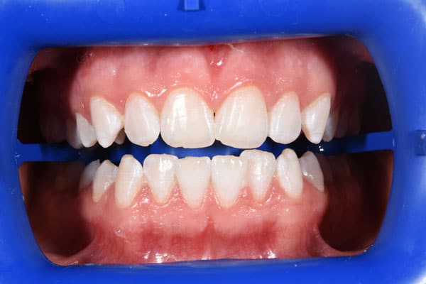 Whitening-after02 Teeth Whitening Before and After | Patient 02 After | The Crown Dental Group