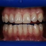 Teeth Whitening Before and After | Patient 01 Before | The Crown Dental Group