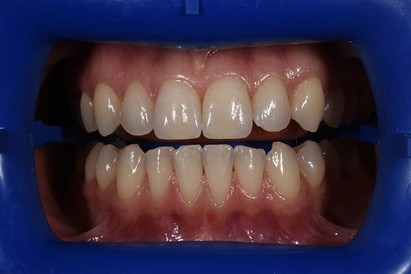 Whitening-before01 Teeth Whitening Before and After | Patient 01 Before | The Crown Dental Group