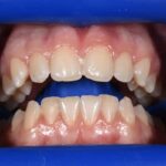 Teeth Whitening Before and After | Patient 02 before | The Crown Dental Group