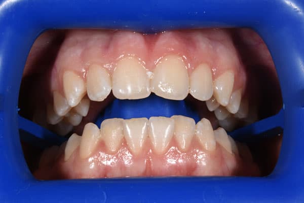 Whitening-before02 Teeth Whitening Before and After | Patient 02 before | The Crown Dental Group