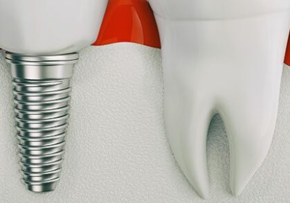 Implant supported dentures