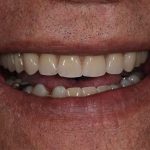 After Dentures