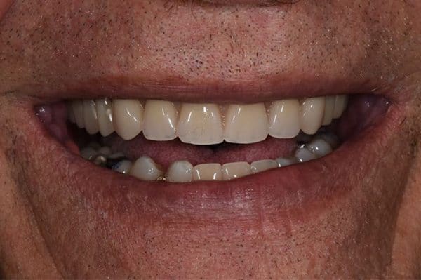 After Dentures After Dentures