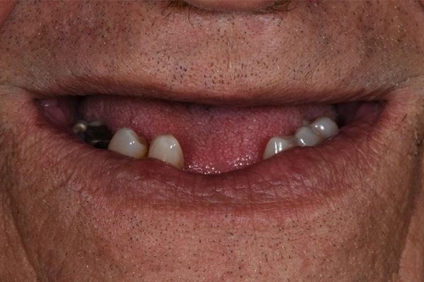 mirobefore Before Dentures