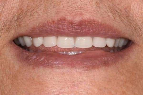 ooafter Complete upper and lower acrylic dentures | After | The Crown Dental Group