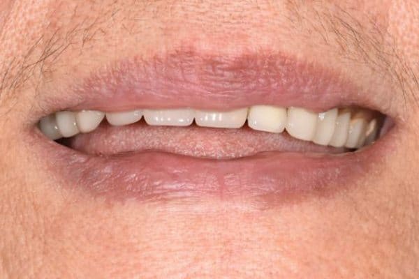oobefore Complete upper and lower acrylic dentures | Before | The Crown Dental Group