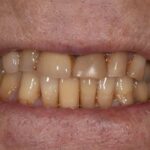 after cosmetic dentistry