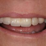 after cosmetic dentistry