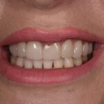 after cosmetic dentistry