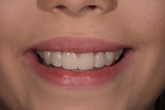 After Caitlin cosmetic dentistry Cosmetic Dentistry Gallery
