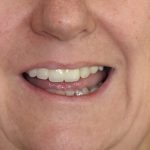 After Jennifer Browning cosmetic dentistry