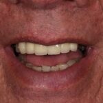 After Keith Sutherland cosmetic dentistry