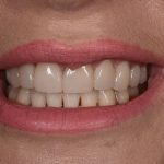 After Nicky Scott cosmetic dentistry