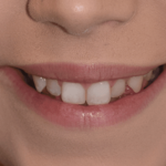 Before Caitlin cosmetic dentistry