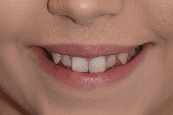 Before Caitlin cosmetic dentistry Before Caitlin cosmetic dentistry