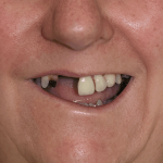 Before Jennifer Browning cosmetic dentistry