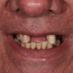 Before Keith Sutherland cosmetic dentistry