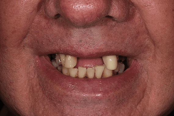 Before Keith Sutherland cosmetic dentistry Before Keith Sutherland cosmetic dentistry