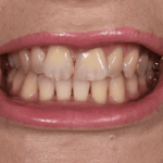 Before Nicky Scott cosmetic dentistry