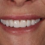 Cosmetic Dentistry Gallery