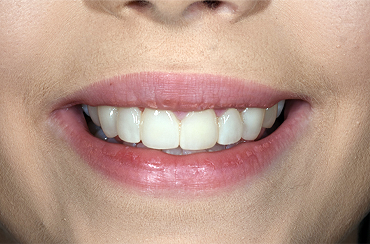 After_2 Cosmetic Dentistry Gallery