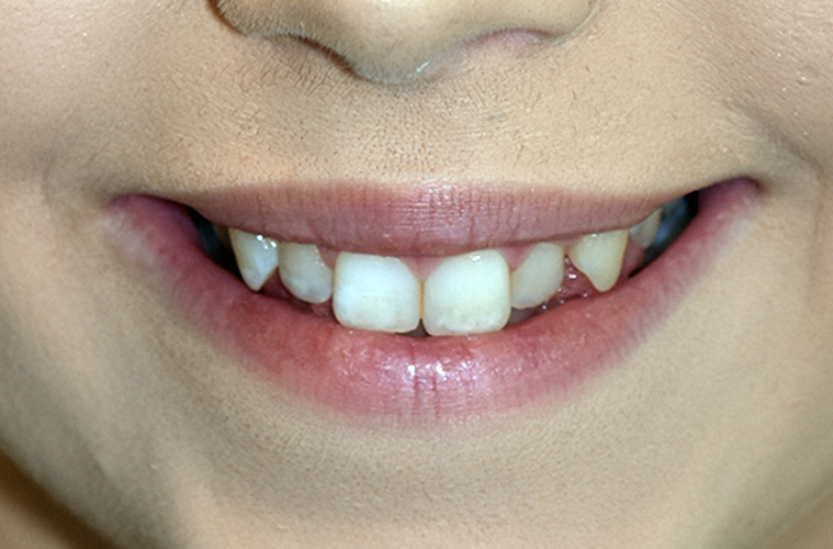 Before_2 Cosmetic Dentistry Gallery