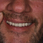 After Cosmetic Dentistry - Crowns, Bridges, Tooth Whitening