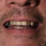 Before Cosmetic Dentistry - Crowns, Bridges, Tooth Whitening